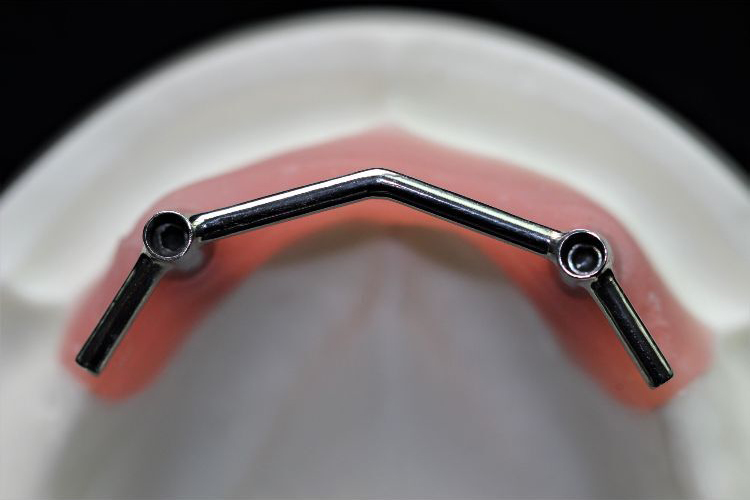 Key points about implant bars